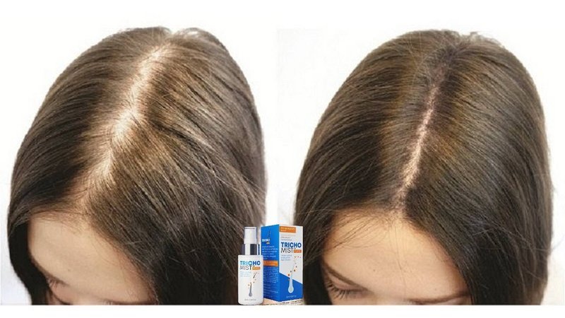 Jakie są najczęstsze pytania na temat Trichomist Forte?, trichomist forte opinie forum